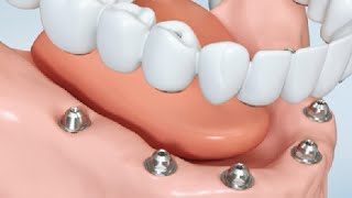 Remplacement de toutes les dents  prothèse fixe  le saviezvous [upl. by Bushweller]