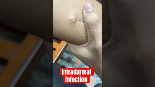 intradermal injection  intradermoterapia  subscribe medicalequipment cannula baby [upl. by Moyers]