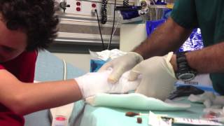 Boxers Fracture  reduction  and splinting [upl. by Naesed]