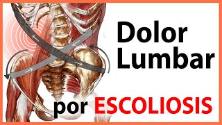 🛑 ¿CAUSAS del Dolor de espalda en la ESCOLIOSIS 👉 Ejercicio Clave  Objetivos en el TRATAMIENTO [upl. by Lowery]