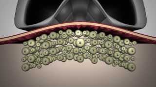 LipoContrast  One step beyond cryolysis [upl. by Eelahc]