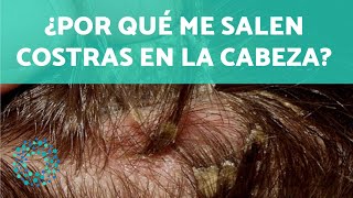 ¿Por qué me salen COSTRAS en la CABEZA  CAUSAS y SOLUCIONES 🤚🏼 [upl. by Elidad]