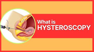 What is Hysteroscopy By Dr Mudita Jain [upl. by Roee]