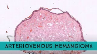 quotArteriovenousquot Hemangioma pathology dermpath dermatology dermatopathology [upl. by Christiane]