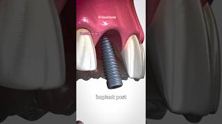 Dental implantsBone Graft dental shorts dentaltreatment twitch youtubeshorts implantfyp [upl. by Dinerman74]