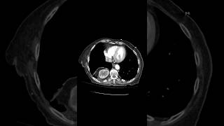 Intrathoracic kidney ct chest reels [upl. by Uttica]