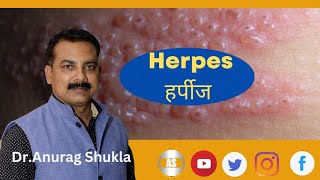 herpes zosterherpes zoster treatmentherpes virusherpes zoster symptoms [upl. by Mulcahy33]