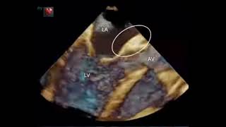 Aneurysm of intervalvular fibrosa [upl. by Bella98]