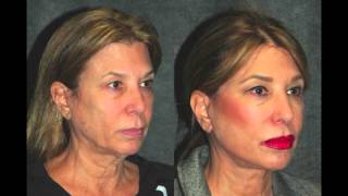 Facelift Recovery in 1 Week After Endoscopic Facelift on 58 Year Old Woman  facelift [upl. by Annawad]