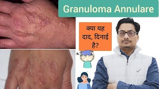 Granuloma Annulare  क्या यह दाद दिनाई है ringworm tinea दाद दिनाई ringwormtreatment fungus [upl. by Blackington603]