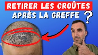 Greffe de cheveux  Les Croûtes après la Greffe  Danger 😱 [upl. by Ydnahs]