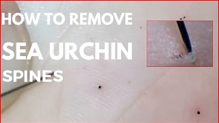 How to Remove Sea Urchin spines on Foot [upl. by Alard]