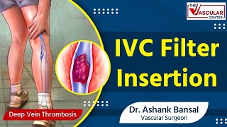 IVC Filter Insertion Advanced Treatment for Deep Vein Thrombosis Explained  Dr Ashank Bansal [upl. by Haland]