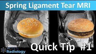 Quick tip 1 Spring Ligament Tear SHORTS [upl. by Beitz]