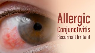 Allergic conjunctivitis [upl. by Mireielle425]