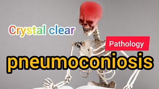 Pneumoconiosis  Pathology  MAT Medicos [upl. by Samale]