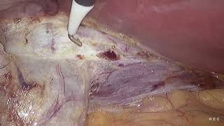 Laparoscopic cholecystectomy unedited 1982024 [upl. by Lenaj]