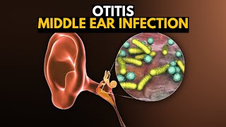 Middle Ear Infection Otitis Media Causes SIgns and Symptoms Diagnosis and Treatment [upl. by Eizzo]