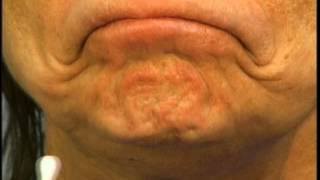 Instructions for Using Botox in the Chin by Dr Elliott of Skinspirations [upl. by Clemens]