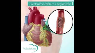 Cateterismo cardíaco e angioplastia [upl. by Ettenoj825]