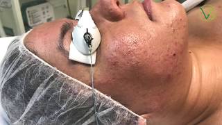 Pixel Fractional Laser Skin Resurfacing for Face area to remove acne scars [upl. by Chiquita]