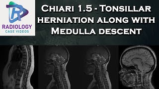 Chiari 15  Tonsillar herniation along with Medulla descent [upl. by Anitsenre]