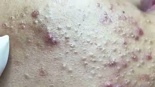 Blackheads amp Whiteheads Satisfying Removal 0053 [upl. by Ainitsirhc852]