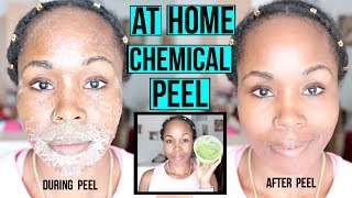 HOW TO Make a NATURAL Chemical Peel AT HOME  ERASE ACNE WRINKLES amp DARK SPOTS [upl. by Niuq]