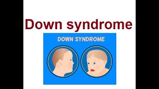 Understanding Down Syndrome Causes amp Treatments  2024 [upl. by Sivartal]