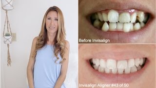 Invisalign Update 4  Progress Pics  Elastics [upl. by Arhna]