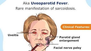 Sarcoidosis ✅ [upl. by Ayoj]