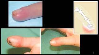 Felon  finger pulp infection [upl. by Prudi]