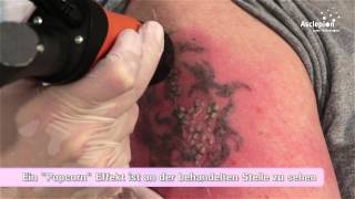 TattooStar  Trainingsvideo zur Tattooentfernung von Asclepion [upl. by Fagaly]