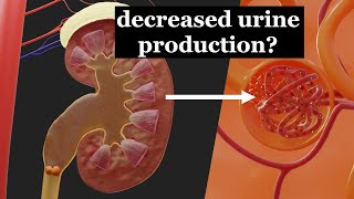 Reduced urine production due to a kidney stone [upl. by Haliak]