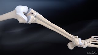 Tibial Nail System—Standard Surgical Technique [upl. by Lucille499]