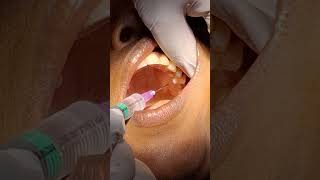 Tooth Extraction by Dr Indu Bhushan BDSMDS RADHA DENTAL CLINIC POLYTECHNIC CHOWK [upl. by Lekzehcey80]