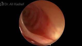 Nasolacrimal duct opening  Hasner’s Valve using 70 degree Endoscope transnasal [upl. by Nedda]