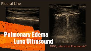 Pulmonary Edema on Lung Ultrasound Perioperative amp Critical Care POCUS [upl. by Allisurd]