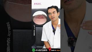 3500 FUE Grafts Hair Transplant by Dr Suneet Soni at Medispa Hair Transplant Clinic in India [upl. by Helas119]