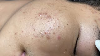 ACNE TREATMENT VU QUYNH MI Acne On Teens Chin 2024 [upl. by Nehtanoj693]