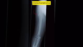 Osteochondroma radiological [upl. by Nahtam]