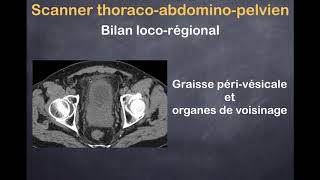 Tumeurs de la vessie  2 Bilan loco régional et à distance [upl. by Spanjian]