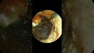 Agonizing Painful Impacted Earwax🤯 [upl. by Jefferson]