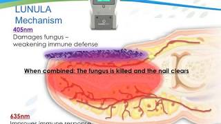 The Science Behind The Lunula Laser For Toenail Fungus Onychomycosis [upl. by Eatnohs]