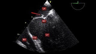 A simple transesophageal echocardiography quiz and introduction to TEE views TOE [upl. by Nwonknu721]