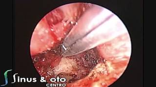 Glomus Tympanicum Endoscopic Transcanal Management [upl. by Wynne446]