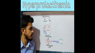 HyperprolactinemiaCausesClinical Features Investigations and Treatment [upl. by Elhsa]