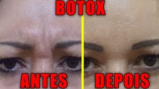 BOTOX NO ROSTO  FAZER OU NÃO [upl. by Divaj]