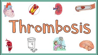 Thrombosis  Definition Causes Types Morphology Fate of a Thrombus amp Clinical manifestations [upl. by Octavie445]