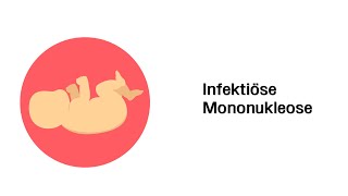 Infektiöse Mononukleose  Infektionskrankheiten  Kinderkrankheiten [upl. by Eenad]